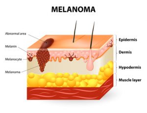 melanoma is not caused by sun exposure