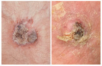 A common skin cancer