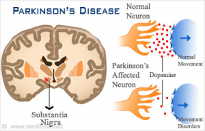 Parkinson's prevented by sun exposure
