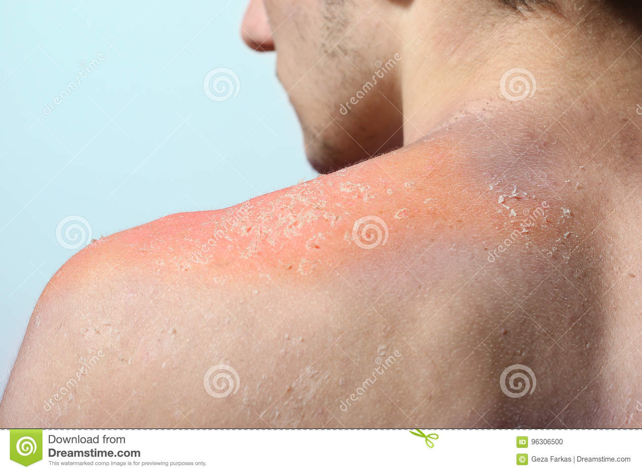 Sunscreens may increase sunburn
